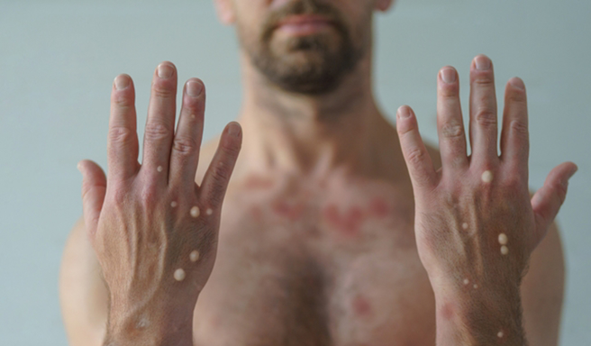 世卫：全球猴痘病例破5万大关 重疫区欧美疫情减缓。(示意图/达志影像)