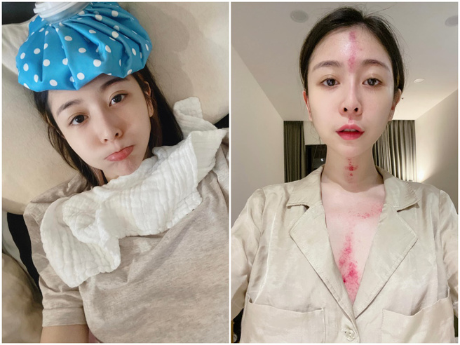 Albee七夕确诊新冠，症状很惨烈。（图／FB@Albee）