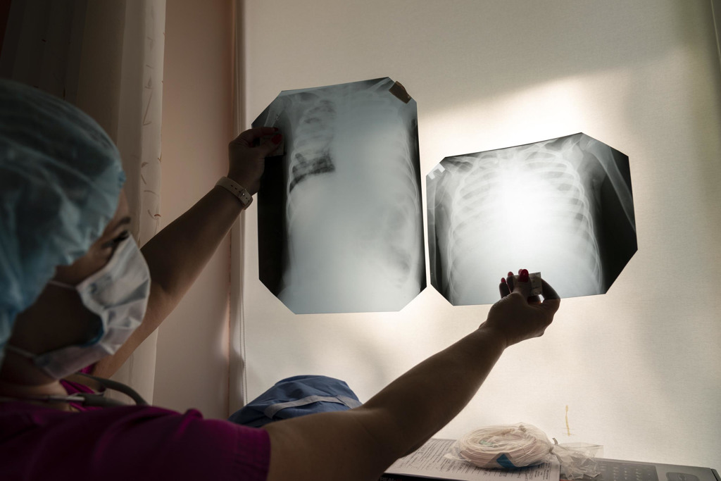 患者X光檢查顯示患有雙側肺炎，恐感染鉤端螺旋體菌。(示意圖／shutterstock)