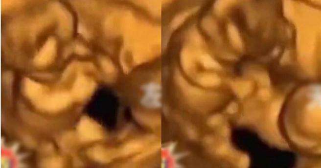 大陸一名2寶媽於網上分享，雙胞胎兒子之前在自己的孕肚中連番「互毆」的超音波畫面，令她哭笑不得。（圖／翻攝自微博／新浪熱點）