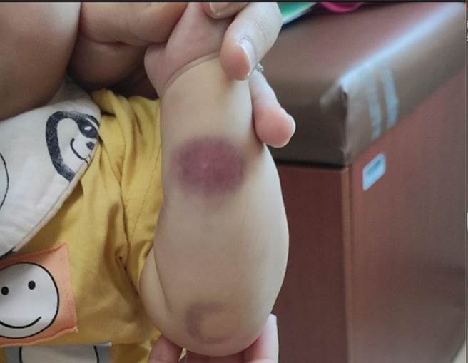 家长发现在没有碰撞的情况下，家中9个月大男婴身上常常莫名出现瘀斑。（新竹马偕提供／王惠慧新竹传真）