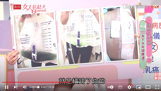 朱芯仪分享移除及重建乳房后，肚子部位的照片（右）。（图／翻摄自 Youtube）