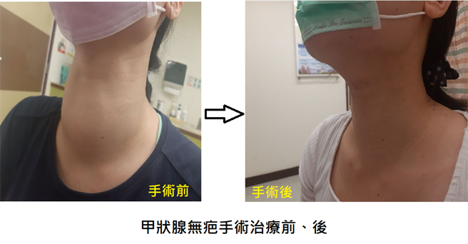 患者甲狀腺左、右側分別長出5公分、4公分腫瘤，術後無留疤也不「燒聲」。（大里仁愛醫院提供／潘虹恩台中傳真）