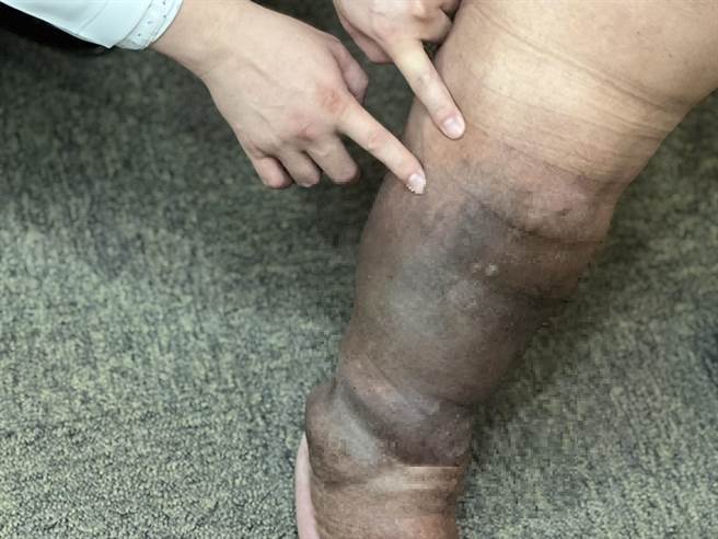 34岁的小维（化名）因为右小腿肿胀且外侧有一个慢性伤口，后来到义大医院就诊，经诊断是因为遗传引起年轻型慢性静脉疾病，经过超显微静脉吻合术的治疗，让他的小腿肚消肿达到10公分。（义大医院提供／林瑞益高雄传真）