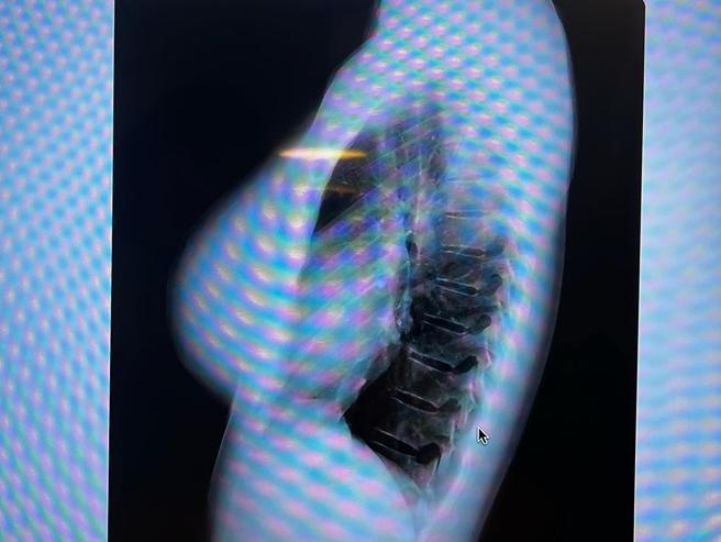 铃木富美奈晒胸部X光照。（图／翻摄自fuminasuzuki IG）