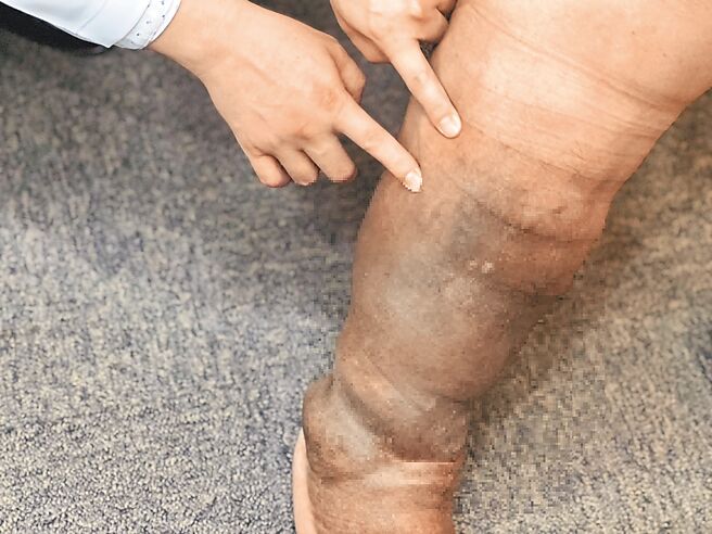 34岁的小维（化名）因为右小腿肿胀且外侧有一个慢性伤口，后来到义大医院就诊，经诊断是因为遗传引起年轻型慢性静脉疾病，经过超显微静脉吻合术的治疗，让他的小腿肚消肿达到10公分。（义大医院提供／林瑞益高雄传真）