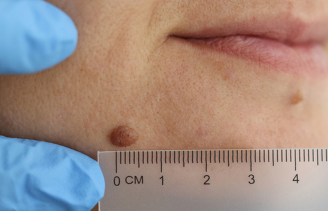 閨蜜狂冒老人斑怕爆，她陪看皮膚科反被查出癌症。（圖／shutterstock）