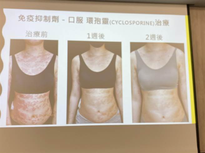 台南一名22岁女大生「宝儿」今年4月底打完第3剂COVID-19疫苗几天后，全身皮肤冒红疹。（曹婷婷摄）