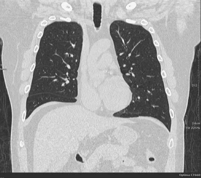 医师指出肺部低剂量电脑断层扫描检查过程仅需10分钟，还能提高癌症早期发现率。（民眾提供／杨静茹南投传真）