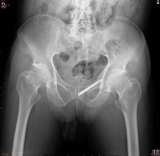 微創骨盆手術僅以1公分左右的傷口，即可將鋼釘固定至骨折位置，可大幅減少術後病人復原時間。（長安醫院提供／潘虹恩台中傳真）