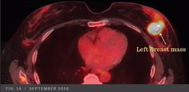 49歲女子左罹患乳癌第四期，左邊乳房上長出腫瘤。（翻攝自《藥物科學、政策和法律》）