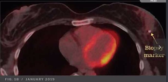 該女子服用大麻二酚及迷幻蘑菇後，左邊的腫瘤幾乎消失。（翻攝自《藥物科學、政策和法律》）