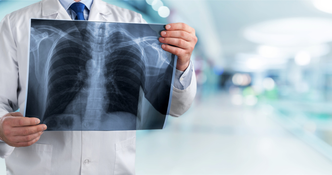 无抽菸习惯却因家族遗传而罹癌，目前最为人知的堪称肺腺癌了。( 示意图/ Shutterstock )