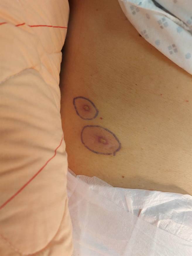 郑男遭蜂螫的伤口。(郑男家属提供)