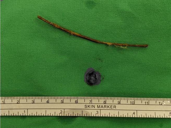 张钰棠表示，这根9公分的树枝富有弹性，比较像叶梗的构造，未被消化液分解就到达12指肠，造成肠穿孔。（高雄医学大学附设中和医院提供／杨舒婷高雄传真）