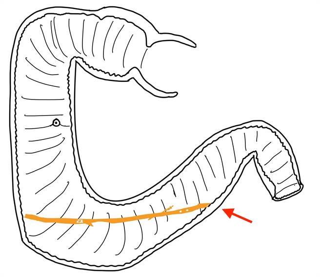 12指肠构造复杂，经过长时间蠕动，树枝不停碰撞肠壁，造成肠穿孔。（高雄医学大学附设中和医院提供／杨舒婷高雄传真）