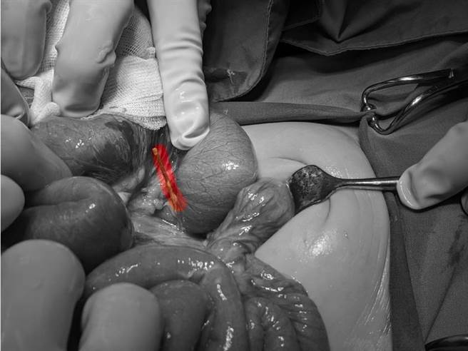 剖腹时医生惊见一根长达9公分的树枝从女童的12指肠穿出，造成女童肠穿孔与腹膜炎。（高雄医学大学附设中和医院提供／杨舒婷高雄传真）
