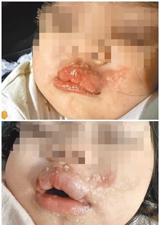 1歲女童燙成香腸嘴 2人妨害幼童發育函送