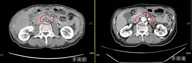 台中60多岁男子因屁股酸麻疼痛、两脚无力跛行，赴台中亚大医院诊断出「脚中风」，术后顺利出院，甚至同步解决勃起障碍。（亚大附医提供／潘虹恩台中传真）