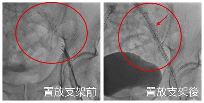 刘殷佐表示，患者肚脐上8公分处以下的主动脉及双侧总肠骨动脉完全阻塞，手术以导管打通置放5支支架，改善阻塞问题。（亚大附医提供／潘虹恩台中传真）