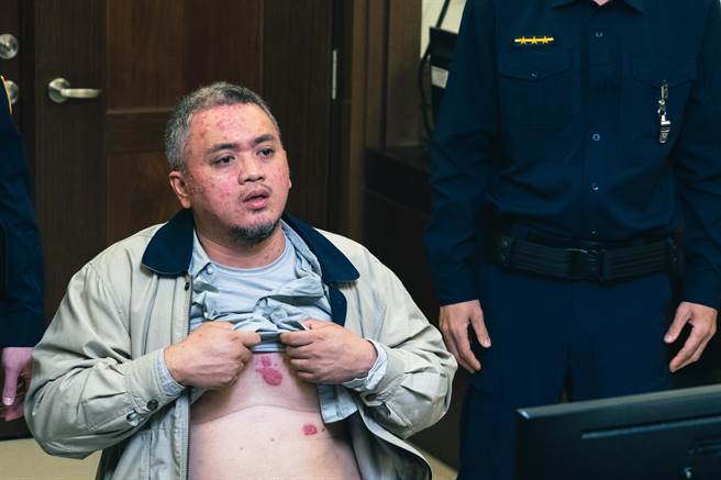 王镜冠脸上红疹、乾癣都是真的。（三禾行销提供）