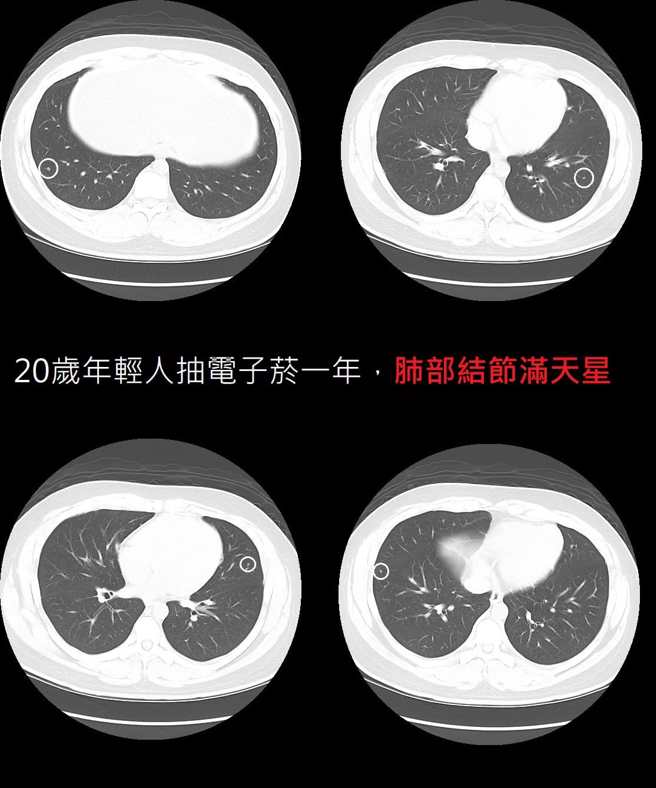 本来不抽菸的20岁男被朋友推坑吸1年电子烟后，肺竟出现满天星肺结节。 (翻摄自苏一峰脸书)
