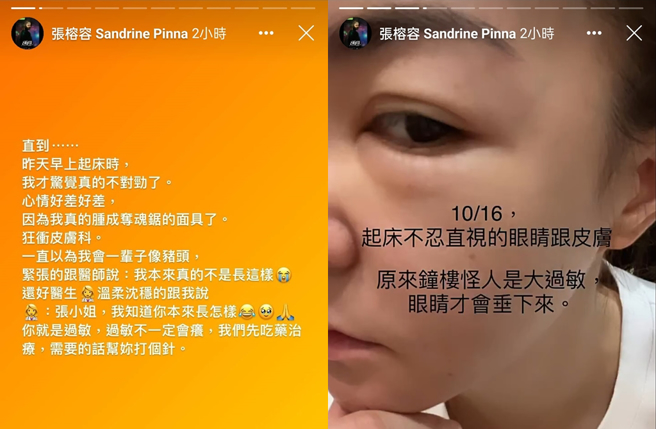 张榕容透露自己过敏。（图／张榕容facebook限时动态）