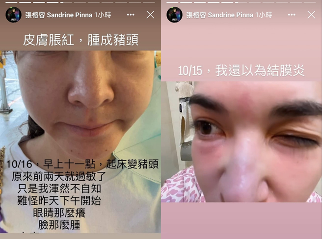 张榕容自嘲肿成猪头。（图／张榕容facebook限时动态）