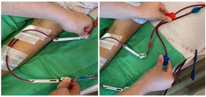 林轩任表示，「血液透析」患者平时若配合医护人员指导练习，操作时间不到10秒钟即可完成。（亚大附医提供／潘虹恩台中传真）