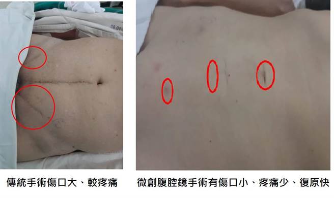 台中50岁林先生近半年来只要搬重物就会下腹疼痛，且两侧腹股沟凸出两个肉球，近期疼痛频率增加，才智大里仁爱医院就医。（大里仁爱医院提供／潘虹恩台中传真）