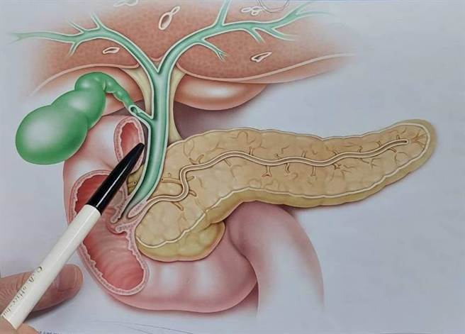 原發性膽汁性膽管炎因肝臟內膽道分泌的膽汁滯留，影響有害物質代謝。（大千醫院提供／李京昇苗栗傳真）