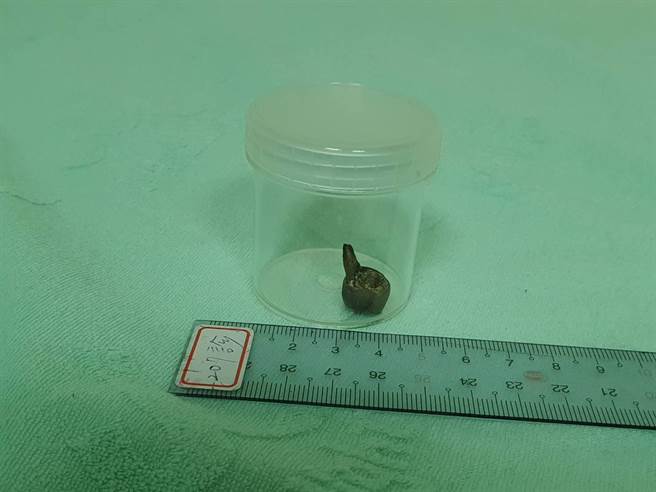 童姓阿嬷肠吞下的假牙龟速在肠胃道移动19天，终于顺利由粪便排出，事后病人的家属也把这一颗假牙妥善保存下来。（林新医院提供／冯惠宜台中传真）