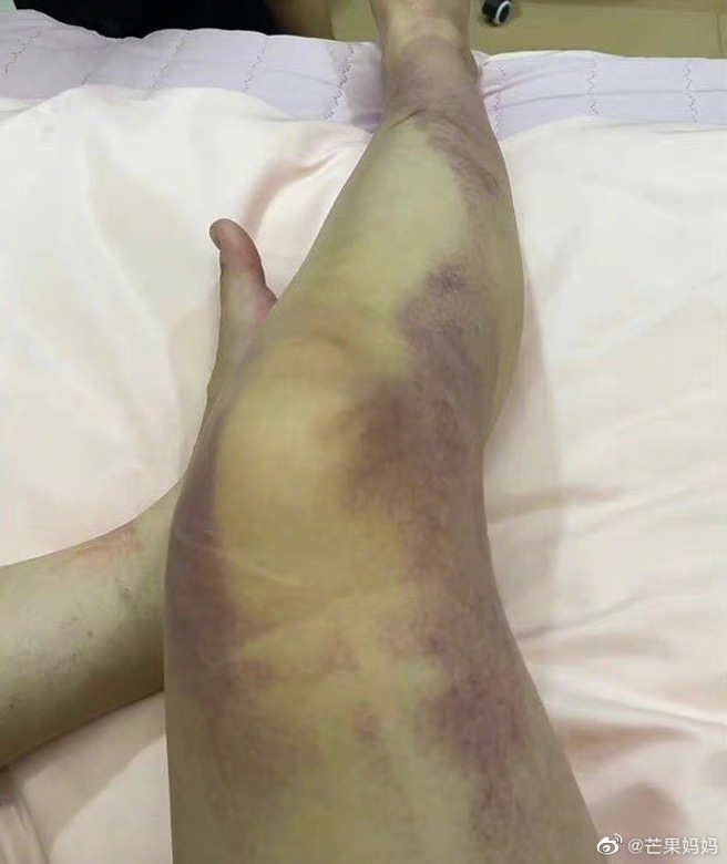 大陆女生的腿被挤压得大片瘀青。（图／翻摄自微博）