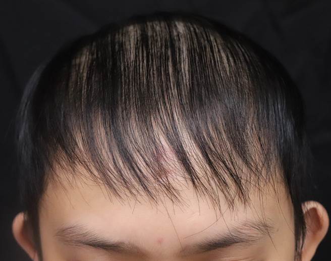 民眾在接种新冠疫苗后一周，出现瀰漫性掉髮。（慈济医院提供／罗亦晽花莲传真）