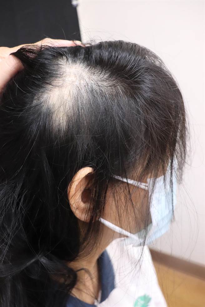 民眾施打新冠疫苗后一周出现圆形秃掉髮。（慈济医院提供／罗亦晽花莲传真）