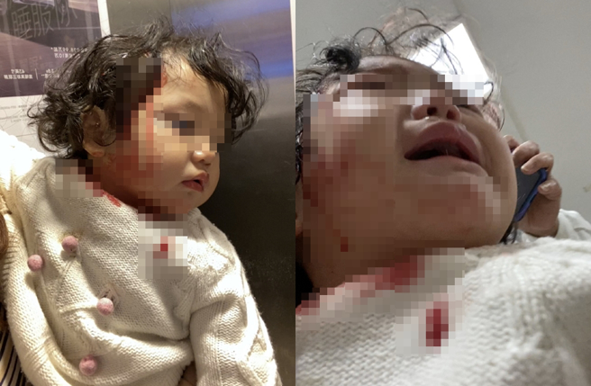 张兆艺晒出女儿头破血流照片。（图／翻摄自张兆艺_zy微博）