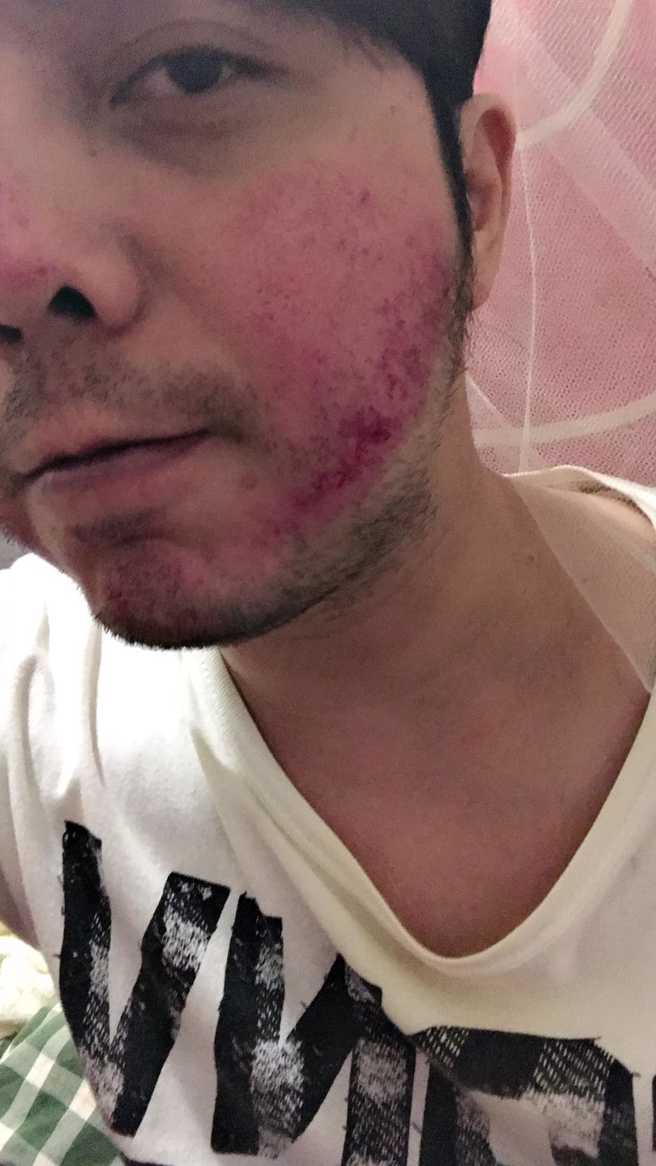 小炳的脸部伤势曝光。（图／FB@余俊贤）