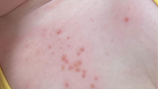 医师顏俊宇表示，近日门诊有不少身上长了「小珍珠」的幼童，这种小珍珠在医学上称为传染性软疣。（图／翻摄自双宝爸的小宇宙｜儿童感染科 顏俊宇医师脸书粉专）