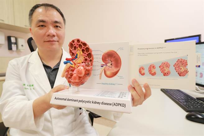 亚大附医肾臟科主任周哲毅指出，多囊肾是显性遗传疾病，不断长大的囊肿会持续损害肾臟功能，易造成洗肾。（亚大附医提供／潘虹恩台中传真）
