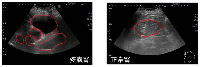 48岁张男近来腹部明显隆起，日前因腰痛、高烧、血尿及血压高挂急诊，发现超音波影像显示其肾臟肿成3倍大、外观如「整串葡萄」，诊断为多囊肾。（亚大附医提供／潘虹恩台中传真）