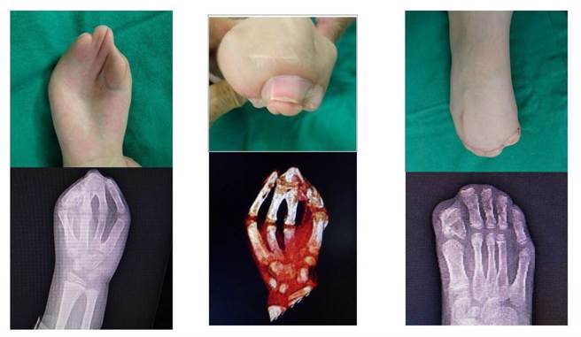 Ochir手、脚原本的模样。（高雄长庚医院提供／袁庭尧高雄传真）