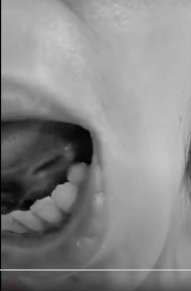 妹子拔牙舌头被钻洞，喝水痛到崩溃。（图／翻摄自爆料公社）