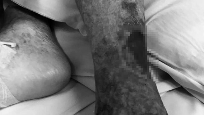 一名女网友表示，高龄90几岁的阿嬷行动不便，近日请照服员到家中替阿嬷洗澡，不慎烫伤阿嬷的小腿。（图／翻摄自爆料公社）