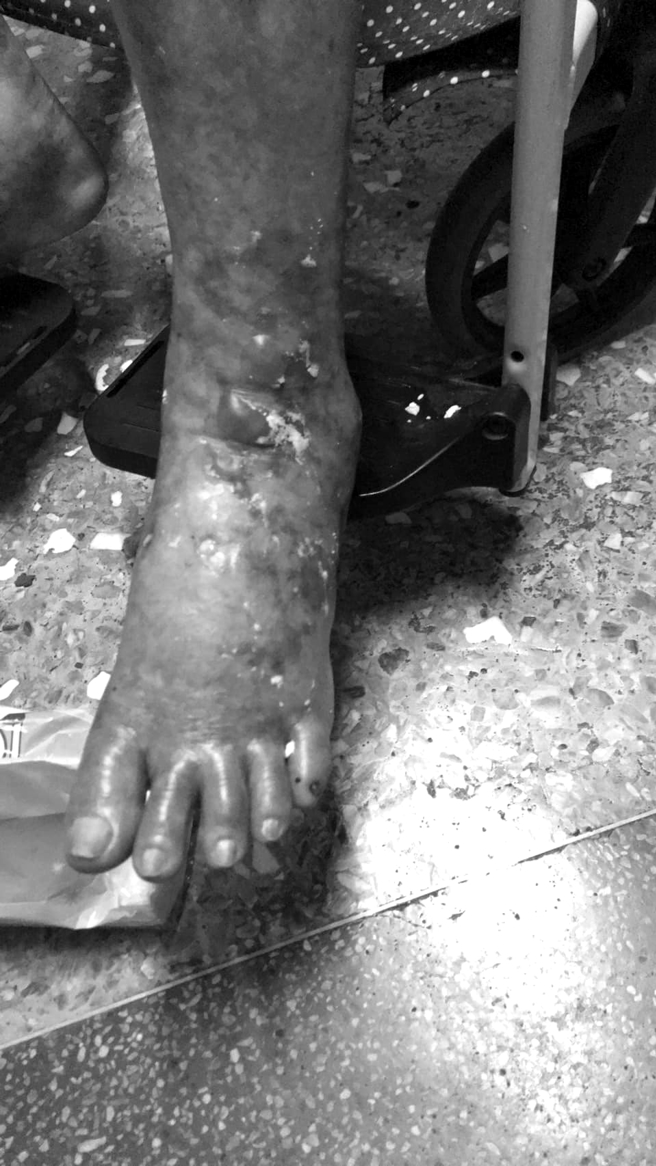 阿嬷脚被烫得红肿。（图／翻摄自爆料公社）