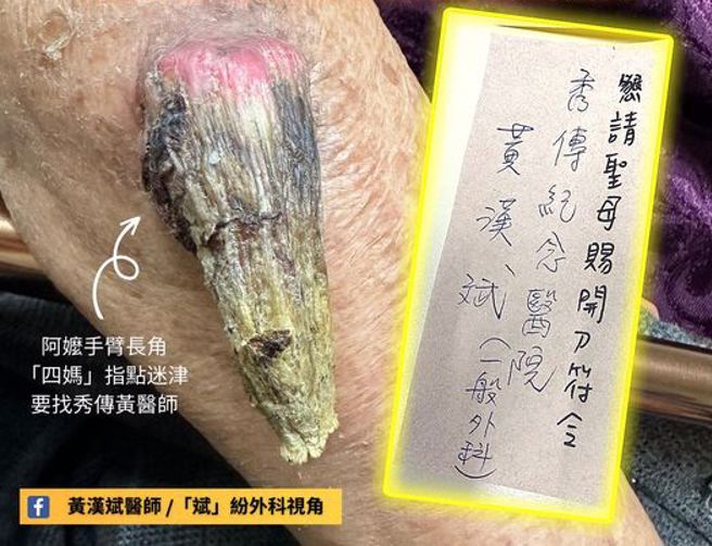 阿嬷手臂长角，妈祖开「仙界转诊单」救人。（图／黄汉斌医师提供）