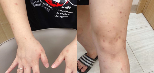 医师顏俊宇表示，近日一名母亲带3岁孩子到他的门诊就医，发现孩子四肢、指缝都有红疹，症状持续一个月，经检查发现是疥虫导致。（图／翻摄自双宝爸的小宇宙｜儿童感染科 顏俊宇医师脸书粉专）