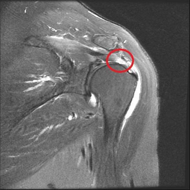 年近60岁的厨师近来发现右手肩膀酸痛，不时有刺痛感，后更严重到一度举不起手，经安排关节镜微创手术后，让他3个月后顺利恢復，找回好刀工。（亚大附医提供／潘虹恩台中传真）