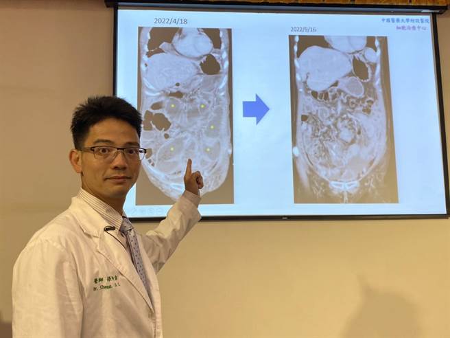 中国附医腹膜肿瘤治疗中心主任张伸吉表示，林小姐大肠癌復发合併腹膜转移，透过合併『免疫细胞疗法』及『腹腔高压气雾化疗』精准医疗辅助治疗，腹腔肿瘤已经大幅较治疗前（图左）减少，且大幅降低恶水（图右）。（冯惠宜摄）