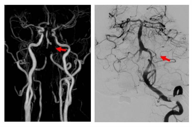 大里仁爱医院脑神经内科医师朱展麟说，脑干仅由椎动脉的细小分枝供应血流，有相当高的再中风风险，经手术放入颅内椎动脉支架，恢復良好。（大里仁爱医院提供／潘虹恩台中传真）