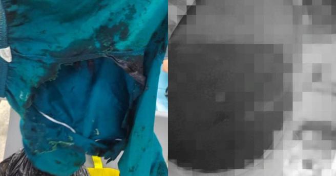 男孩因为滑倒，一屁股坐到强酸液体，裤子被烧成大洞。（图／红星新闻）